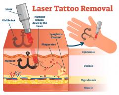 How does laser tattoo removal work?