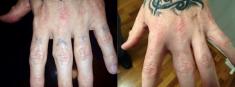 Free Laser Tattoo Removal Harrington Park Health Professionals _small