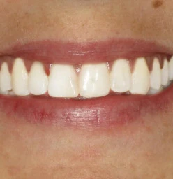 New Patient Offer Kelmscott Dental